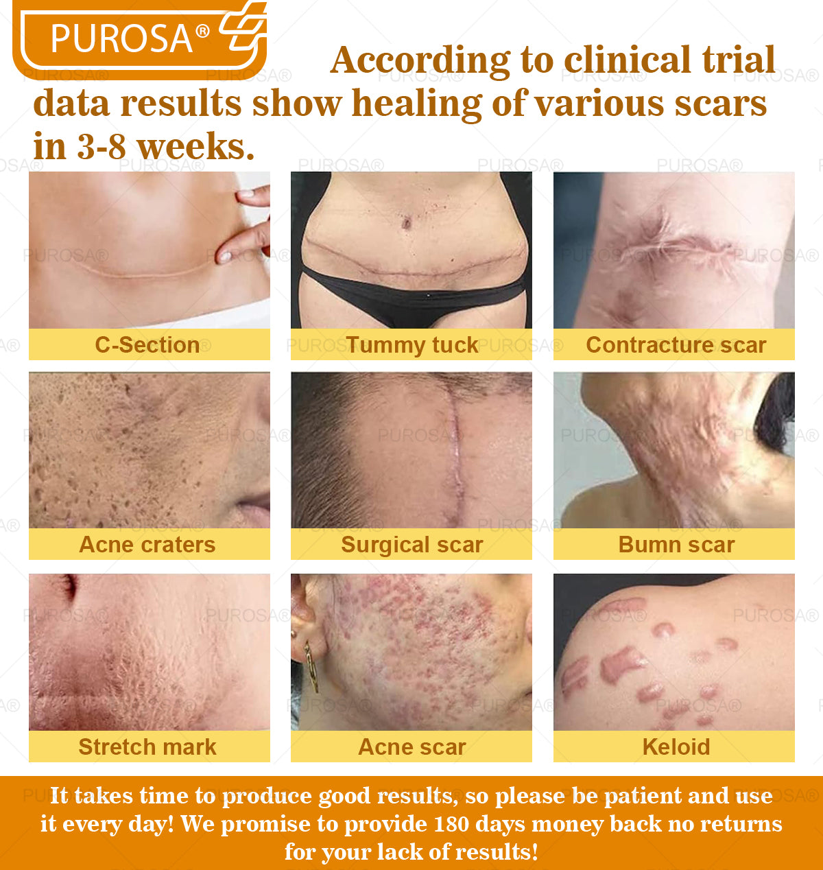 PUROSA® Bee Venom Skin Treatment Cream, Anti-aging, Hydrating, Skin Repair, Even Tone, Acne and Dark Spot Treatment, Wart and Mole Removal, Psoriasis Relief