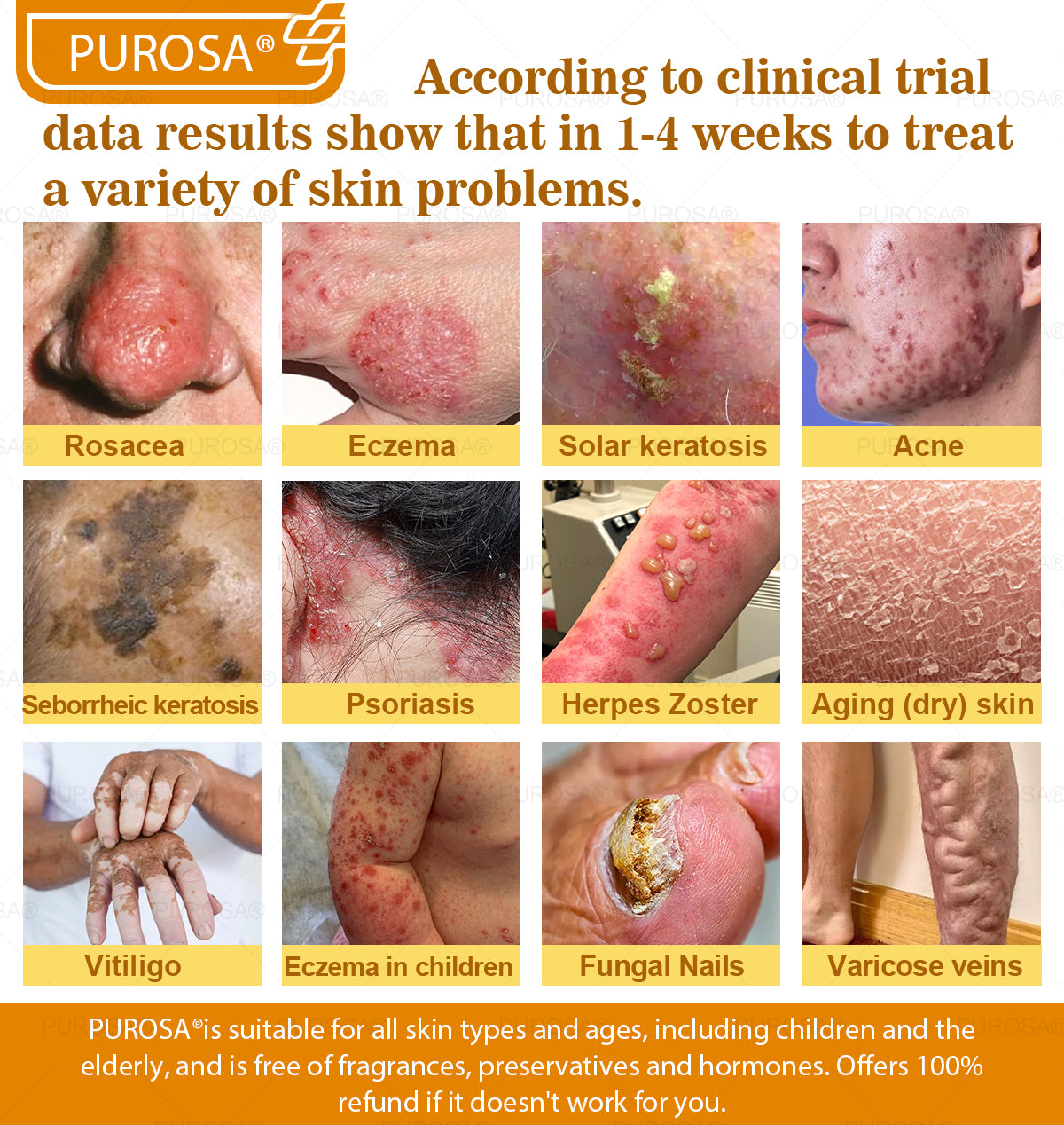 PUROSA® Bee Venom Skin Treatment Cream, Anti-aging, Hydrating, Skin Repair, Even Tone, Acne and Dark Spot Treatment, Wart and Mole Removal, Psoriasis Relief
