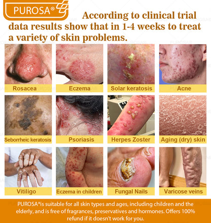 PUROSA® Bee Venom Skin Treatment Cream, Anti-aging, Hydrating, Skin Repair, Even Tone, Acne and Dark Spot Treatment, Wart and Mole Removal, Psoriasis Relief