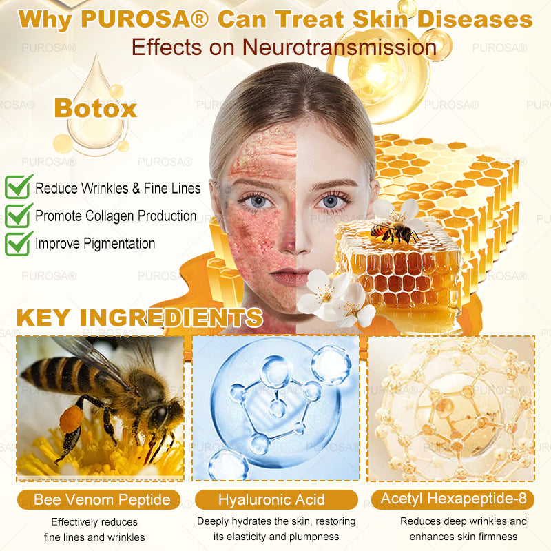 PUROSA® Bee Venom Skin Treatment Cream, Anti-aging, Hydrating, Skin Repair, Even Tone, Acne and Dark Spot Treatment, Wart and Mole Removal, Psoriasis Relief